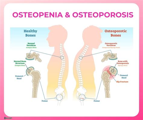 OSTEOPENIA - Symptoms, Causes, Risk Groups, Prevention and Treatment ...