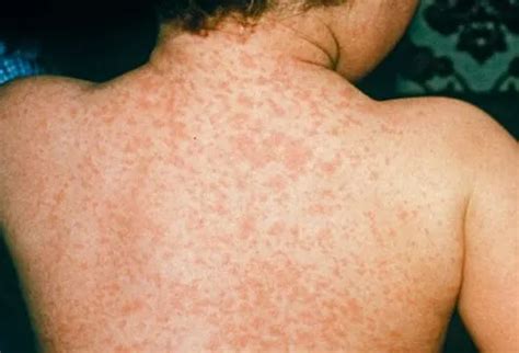 Measles Pictures, Treatment, Causes, Symptoms & MMR Vaccine - Okkii.com