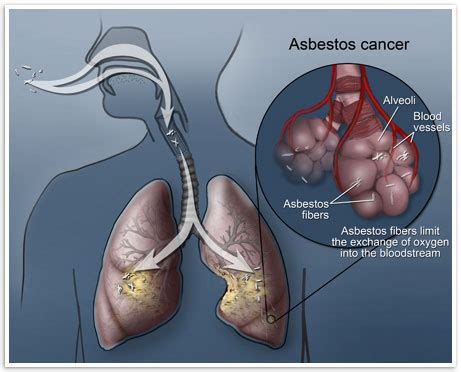 Asbestos Cancer | Mesothelioma