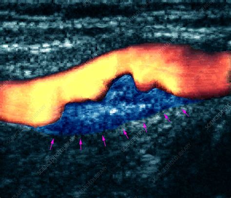 Atheroma plaque, Doppler ultrasound - Stock Image - M175/0299 - Science ...