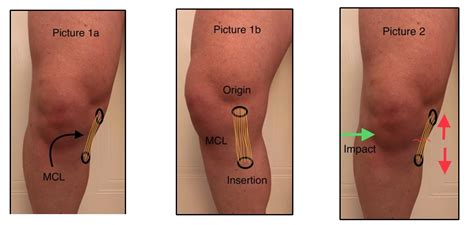 Tibial Collateral Ligament Pain