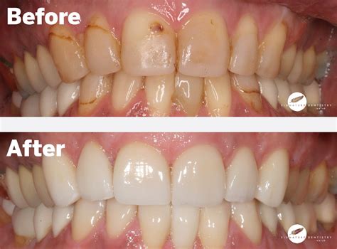 Porcelain Veneers Melbourne - Cost of Veneers - Signature Dentistry