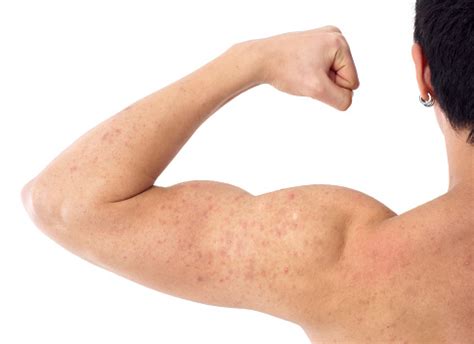 Acne On A Males Arm And Shoulder Stock Photo - Download Image Now ...