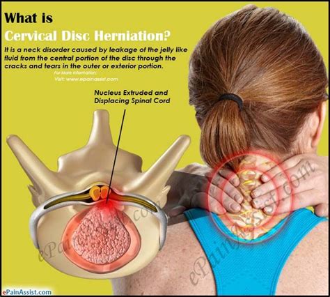 What is Cervical Disc Herniation?