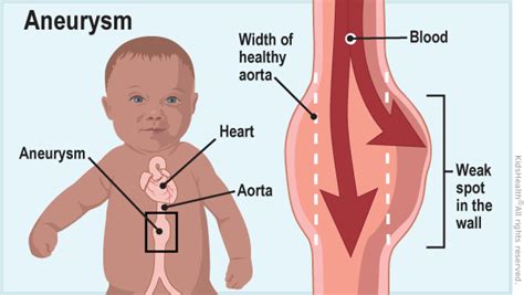 Aortic Aneurysm | Rady Children's Hospital