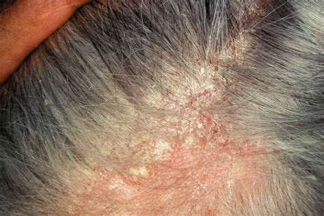 Seborrheic Dermatitis vs. Psoriasis: Scalp Differences