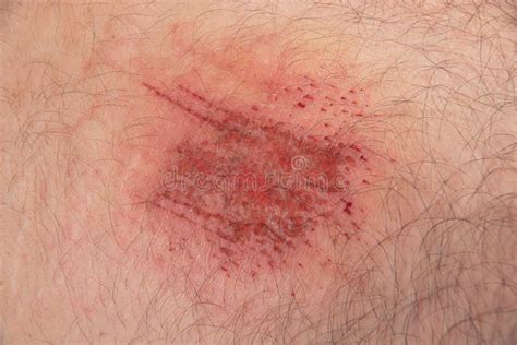 Abrasion Wound in Caucasian Skin Close Up Stock Image - Image of human ...