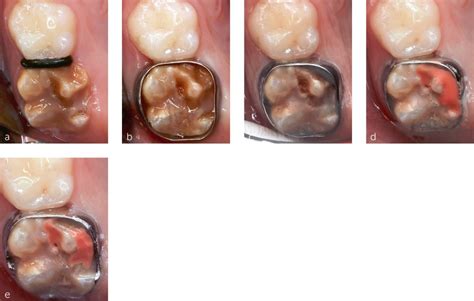 Direct restorations | Pocket Dentistry