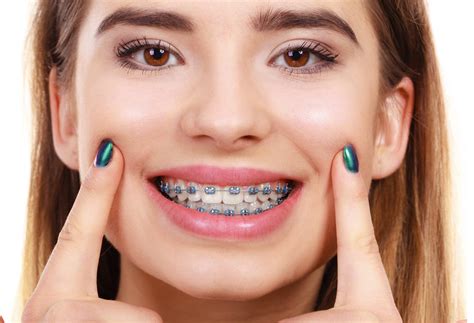 Fast Braces Pros and Cons: Should You Get Them?