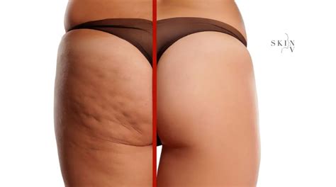 The Truth About Cellulite: Causes & Prevention | Skin NV Clinic