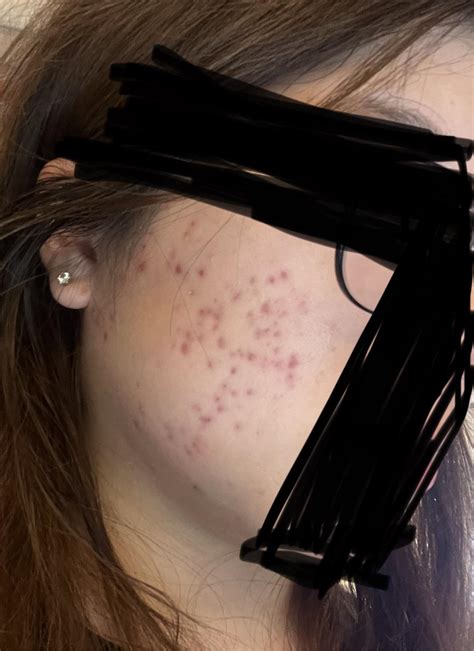 Hyperpigmentation/scars : r/acne