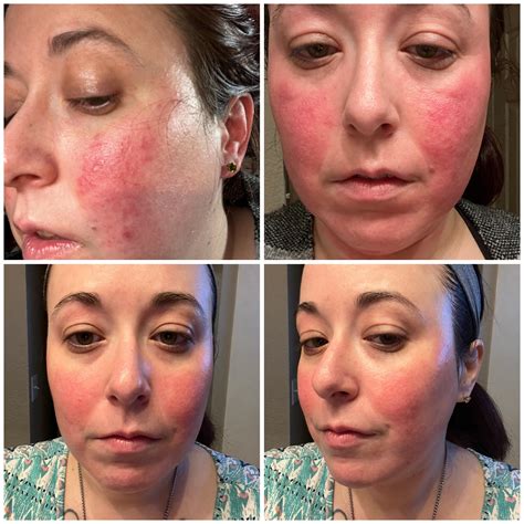 My Three Month Rosacea Journey with prescription topicals and otc ...