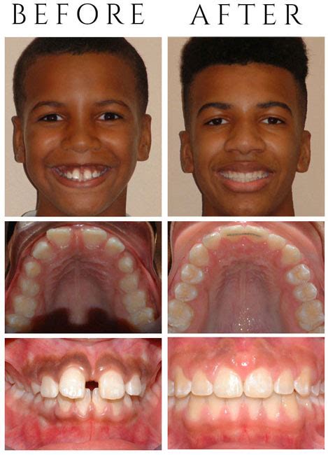 Palate Expander Before And After