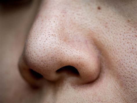 Large Skin Pores