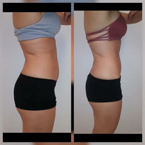 Posh Body Slim #1 Body Contouring | No Surgery. No Pain.