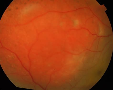 Diffuse Choroidal Hemangioma - Retina Image Bank