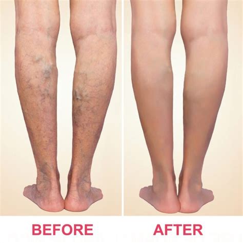 Varicose Veins Treatment Mumbai | Dr. Jathin's Vein Center