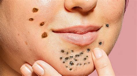 Newest Blackhead Removal Videos 2024 – Youtube - Eula Laurella