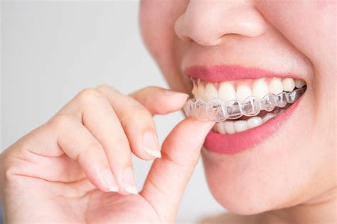 What Are Invisalign Attachments? | Smile Stories