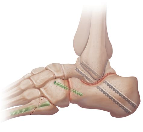 Arthrex - Subtalar Arthrodesis