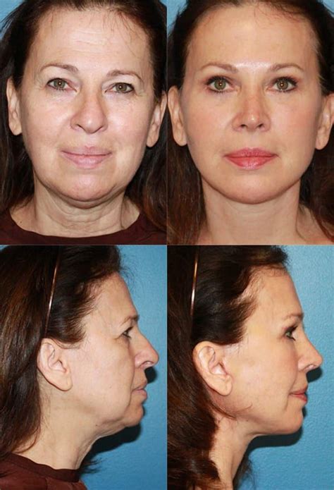 Neck lift before after photos from dr kevin sadati – Artofit