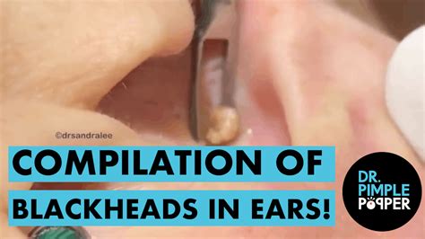 A Compilation of Blackheads in The EARS - Dr. Pimple Popper