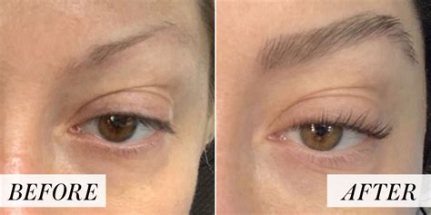 Getting an Eyebrow Transplant Changed My Life - Worlds Family Medicine