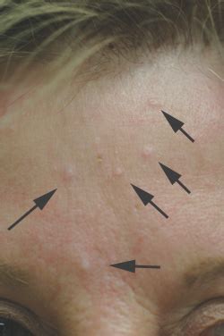 Sebaceous Hyperplasia Chin