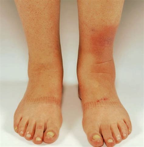 Pretibial Myxedema - Pictures, Treatment, Symptoms, Causes - HubPages