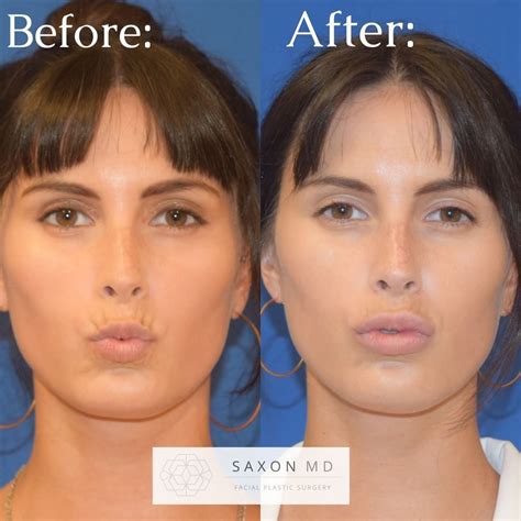 Before and after of lip filler Notice how the filler only injected into ...