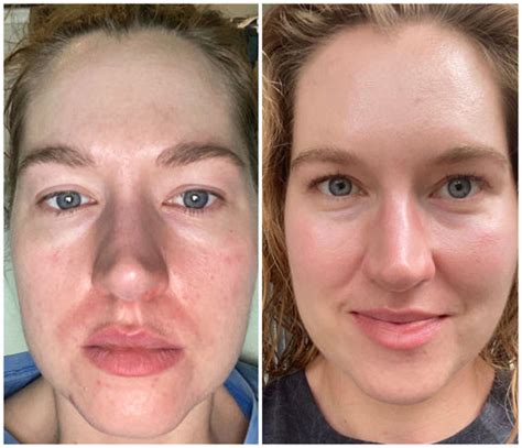 Tretinoin Before and After Photos: How Do You Know it Will Work for Yo ...