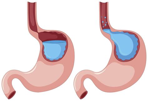 Sự khác nhau giữa bệnh trào ngược dạ dày và bệnh viêm loét dạ dày