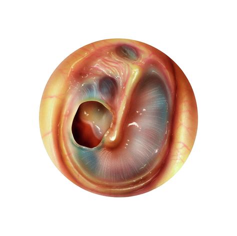 Perforated Eardrum Photograph by Bo Veisland/science Photo Library - Pixels