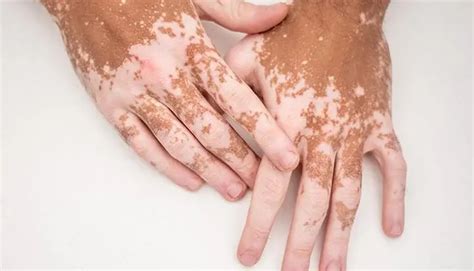 Understanding Vitiligo in Children: Early Symptoms and Causes