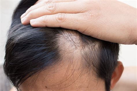 Alopecia Areata (AA) - Symptoms - familydoctor.org