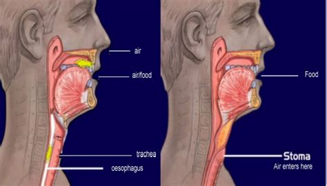 What is a Laryngectomy? - NALC | The National Association of ...