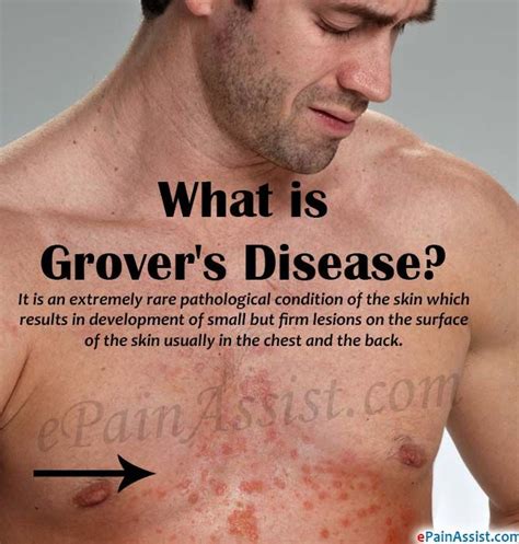 Grover's Disease is an extremely rare pathological condition of the ...