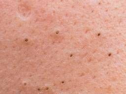 Blackheads: Facts, causes, and treatment