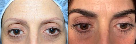 Eyebrow Hair Transplant photos | Miami, FL | Patient108448