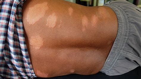 What Is Leprosy? Symptoms, Causes, Diagnosis, Treatment, and Prevention ...