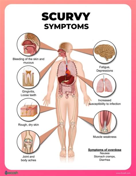 SCURVY (VITAMIN C DEFICIENCY) - Symptoms, Causes, Risk Factors and ...