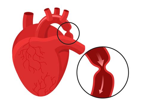 Cardiovascular Thoracic Surgery | Bombay Hospital