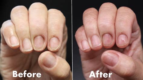 Why Are My Nails Peeling? Causes Of Flaking, Peeling Nails | atelier ...