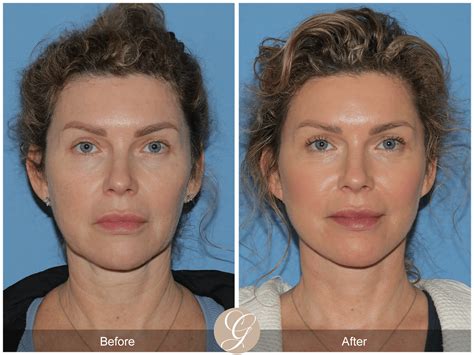 Lower Facelift & Deep Plane Necklift Case 2 Before After Photos Orange ...