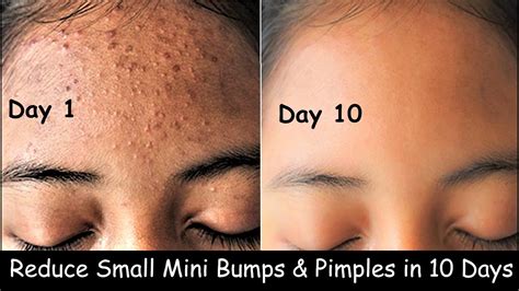 How To Get Rid Of Little Pimples - Considerationhire Doralutz