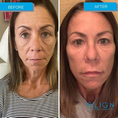 Before and After Xeomin® Injections | Align Injectable Aesthetics