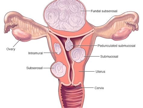 Types of Uterine Fibroids | Best Treatment for Fibroids in Trivandrum