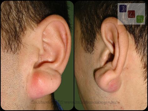 Painful Cyst Behind Ear