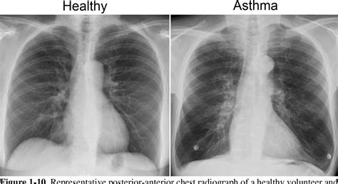 Pulmonary Imaging to Better Understand Asthma | Semantic Scholar