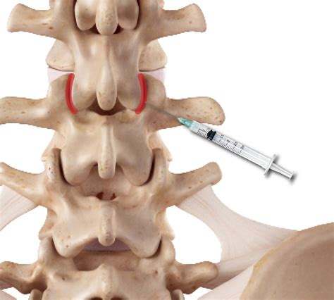 Lumbar Facet Joint Arthritis